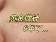 汉密尔顿美容院：黄金微针治疗的显著效果与积极体验