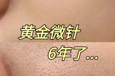 汉密尔顿黄金微针治疗：精准、安全与高效的皮肤焕新方案