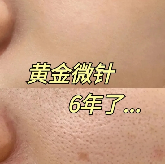 汉密尔顿美容院：黄金微针治疗的显著效果与积极体验