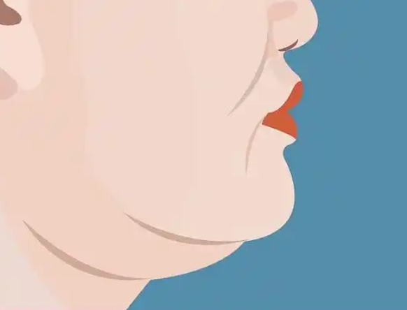 精雕吸脂